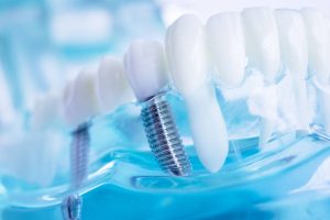 Why do Dentists Use The All-On-4 Procedure