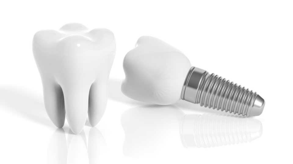 dental implants 3d model